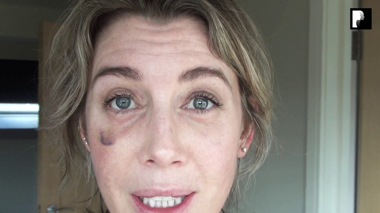 Blepharoplasty Video Diary 3 Weeks After Surgery (13 of 15) YouTube Blepharoplasty Video Diary 3 Weeks After Surgery (13 of 15) YouTube