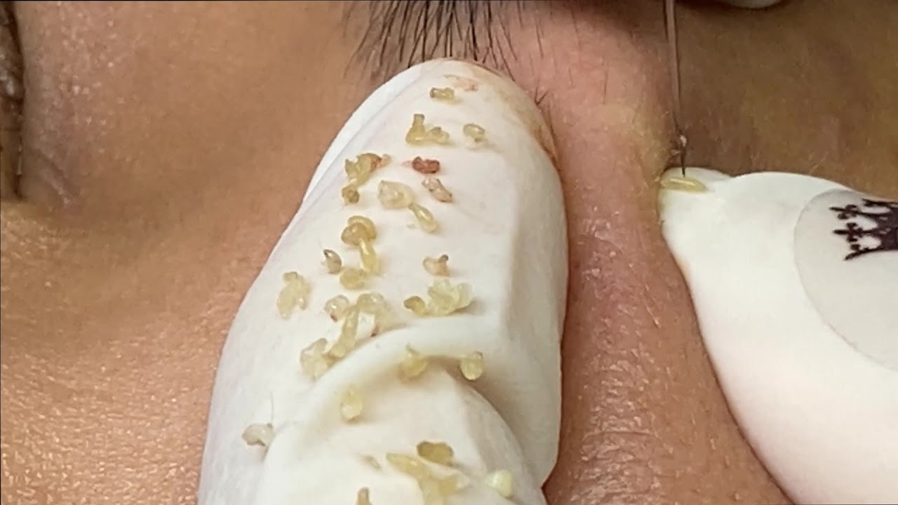 Pimples, Blackheads Under The Skin | Mụn Ẩn Dưới Da - SacDepSpa#150