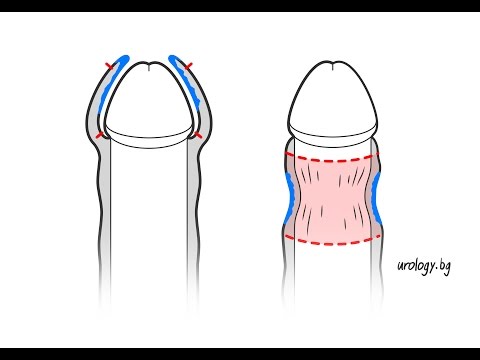 Видео: Пилинг на кожата на пениса: причини, лечение и кога да потърсите помощ