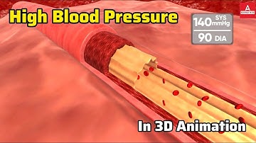 High Blood Pressure Explained in 3D | Understanding Hypertension