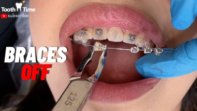 What does a reverse curve wire do for braces? Tooth Time Family