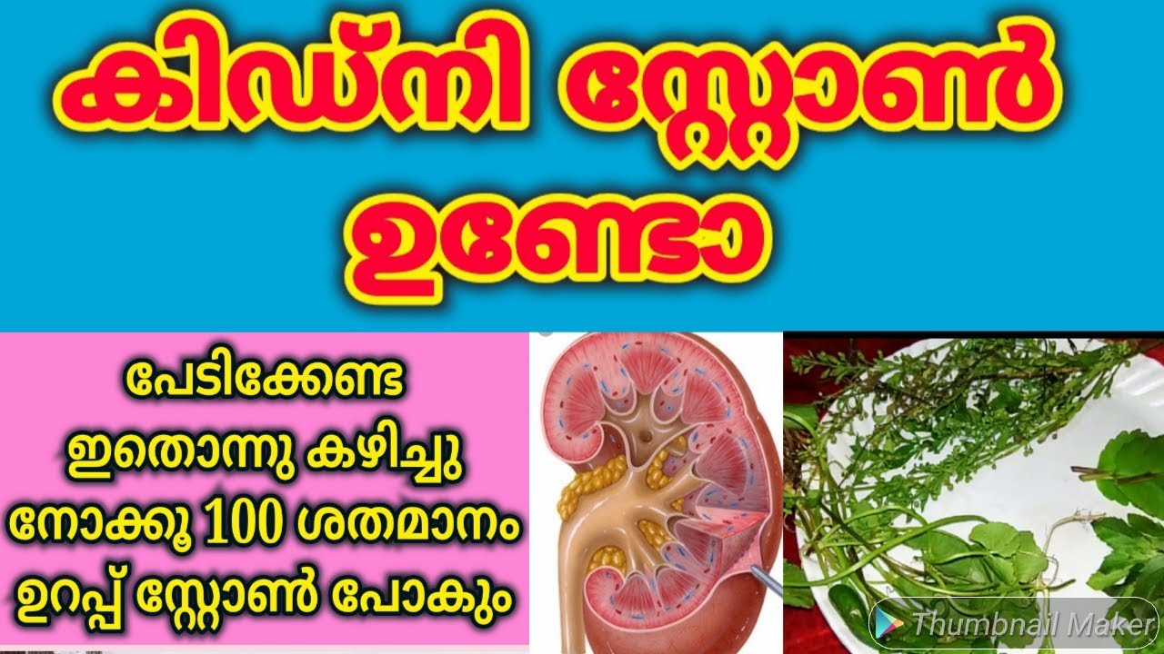 Kidney Stone Treatment Malayalamകിഡ്നി സ്റ്റോൺ അലിയിച്ചു കളയാം ഈ ഒരു