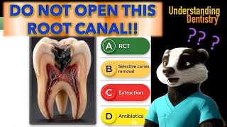 Avoid the Root Canal! Selective Caries Removal for Deep Cavities