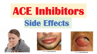ACE Inhibitor Side Effects: Lisinopril, Ramipril, Captopril, Perindopril | Causes and Why They Occur
