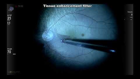 Alcon Ngenuity Tissue enhancement by Lukan Mishev