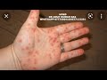 HAND FOOT &amp; MOUTH DISEASE SYMPTOMS/CAUSES/PREVENTIONS.हाथ पैर और मुंह रोग के लक्षण / कारण / रोकथाम।