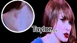 "Taylor Swift's Surprise Hickey? Explained!"