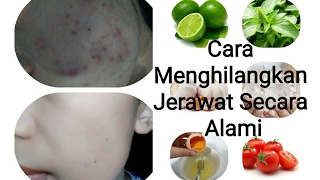 Terbukti !! Cara Mengobati Jerawat Batu dengan cepat | Obat Jerawat