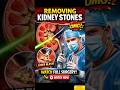 How Doctors Remove Kidney Stones 😳