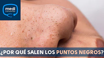 ¿Cómo se llaman los puntos negros de mi cuerpo?