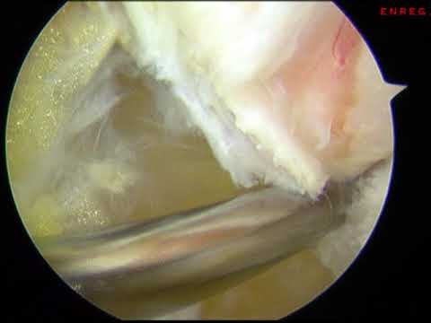 Ligamentoplastie cheville (type anatomique) - 2/7