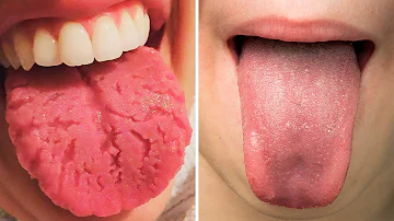 Cosa provoca i tagli sulla lingua?