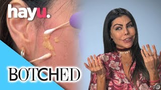 Pus Oozes Out Of Liziane's Face! | Botched