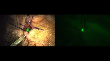 Melanoma Sentinel Lymph Node Biopsy Guided By a Fluorescent Probe