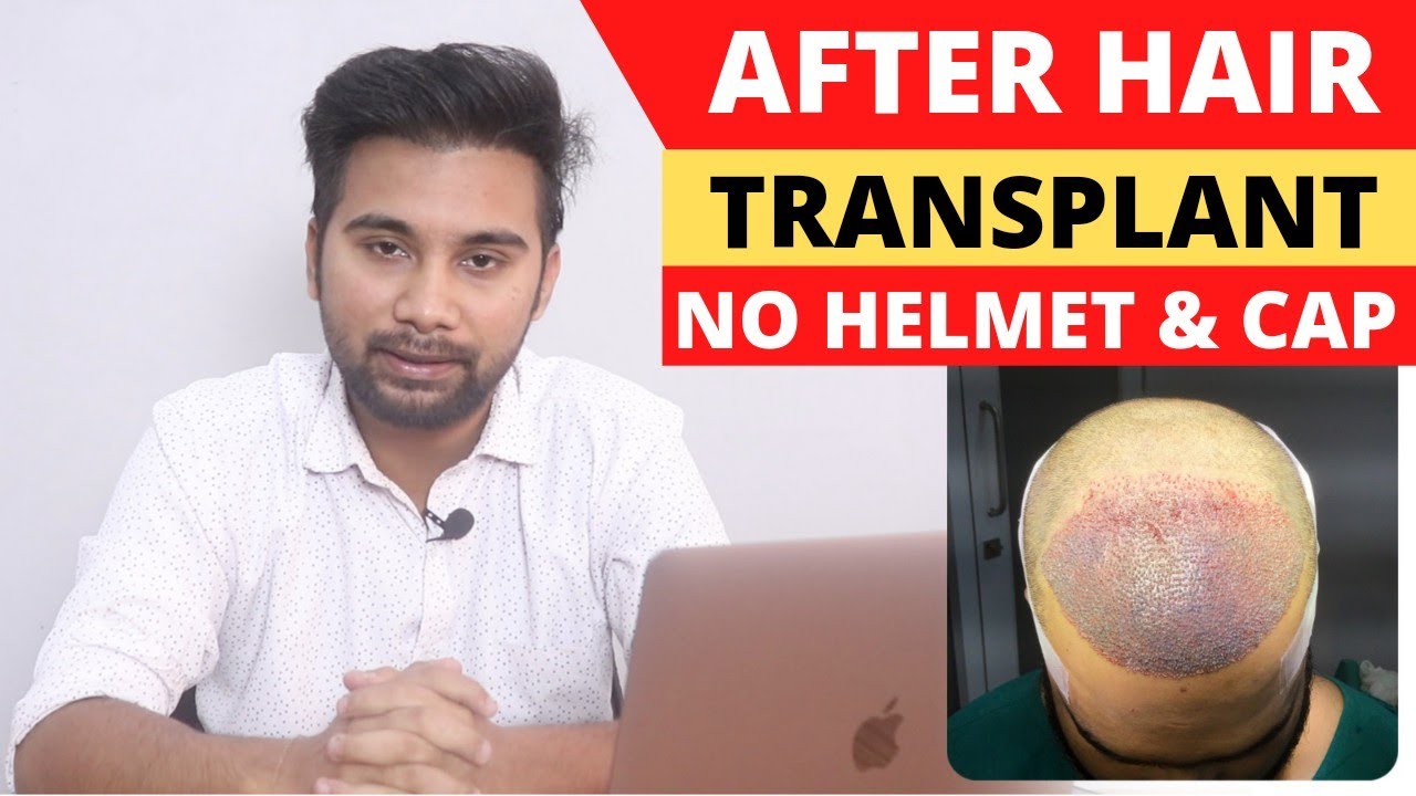 Why Can't We Use Helmets and Cap After Hair Transplant Precautions