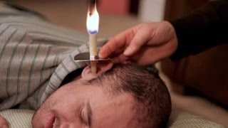 The danger of ear candling