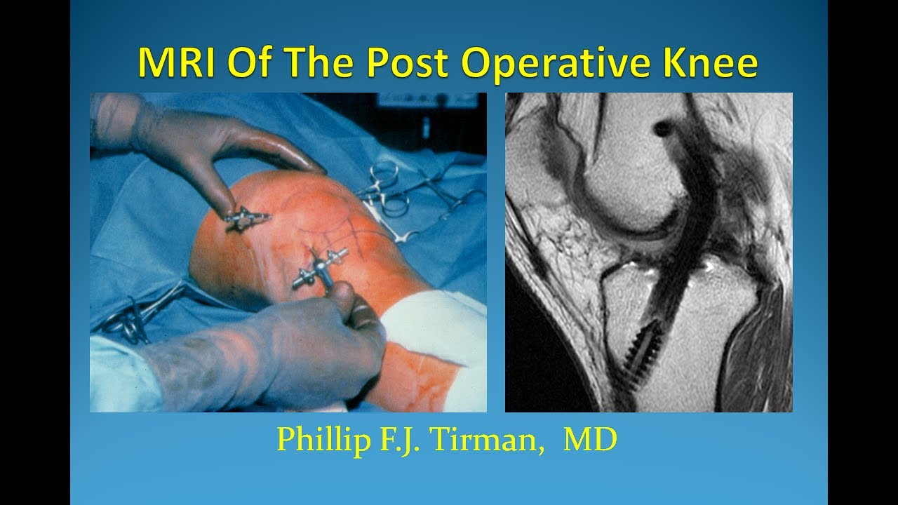 MRI of the Postoperative Knee - by Phillip Tirman, MD