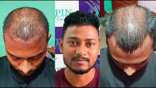 Best Hair Transplant clinic in Bhubaneswar,  Odisha | Genuine client testimonial | Success Stories