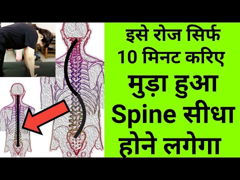 वीडियो: स्कोलियोसिस का इलाज कैसे करें: 15 कदम (चित्रों के साथ)