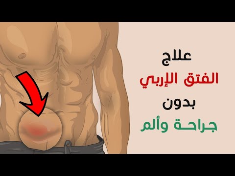 أحدث وأفضل التقنيات لعلاج الفتق الإربي بدون ألم الذي يصيب معظم الرجال #طبيبك_اليوم