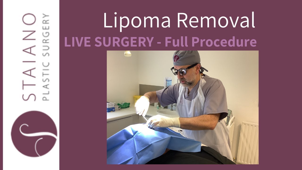 [LIVE SURGERY] Lipoma Removal