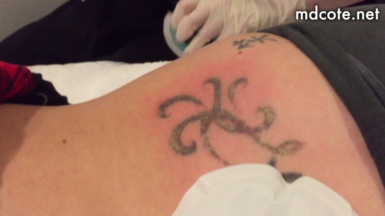 Tattoo Removals in Perth | Painless & Affordable Tattoo Removal