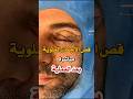 عملية شدالجفون العلوية لمراجعنة الغالي اكسبلور ترند شيراز شد الجفون