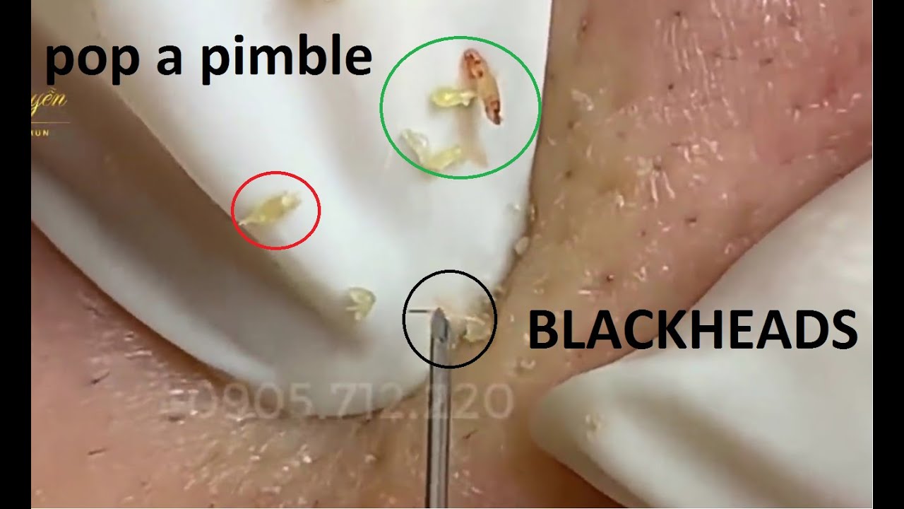 Blackheads Etraction On The Face 18 Loan Nguyen Youtube