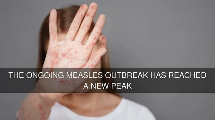 The Ongoing Measles Outbreak Has Reached a New Peak