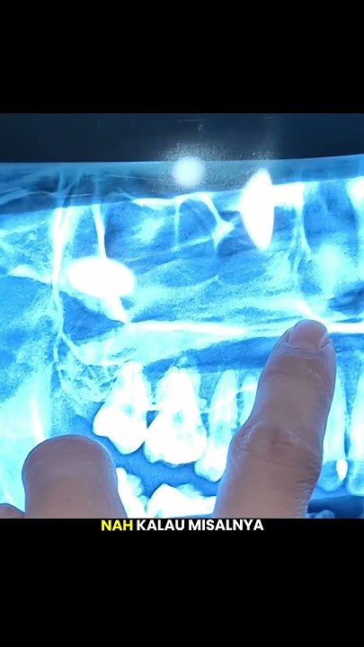 don't underestimate the remaining tooth roots #remainingroots #toothache #cavities #dentaleducati...