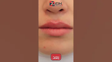 نتائج قبل وبعد مذهلة لإجراء فيلر الشفاه في مشفى زين 