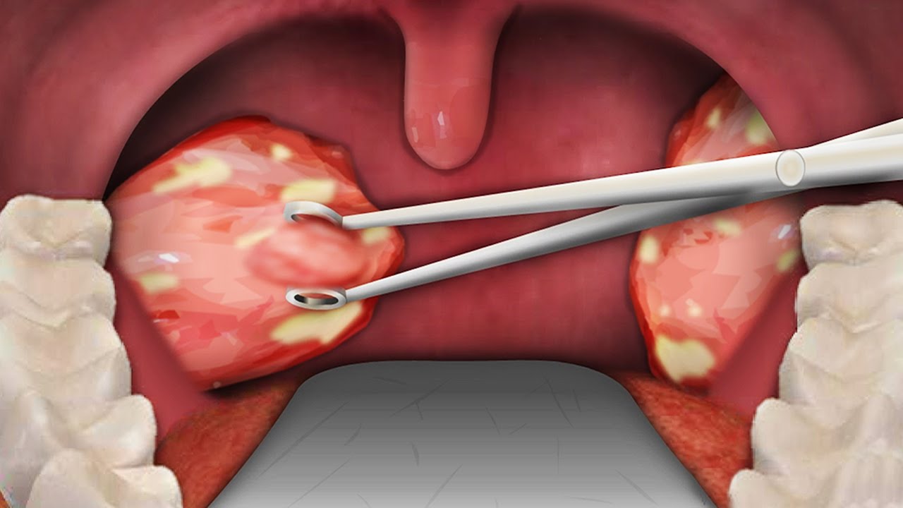 Adult Tonsil Surgery 92