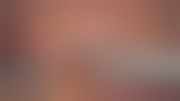 Right Laparoscopic Partial Nephrectomy for endophytic renal mass.