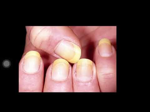 Yellow Nail syndrome OSCE medicine