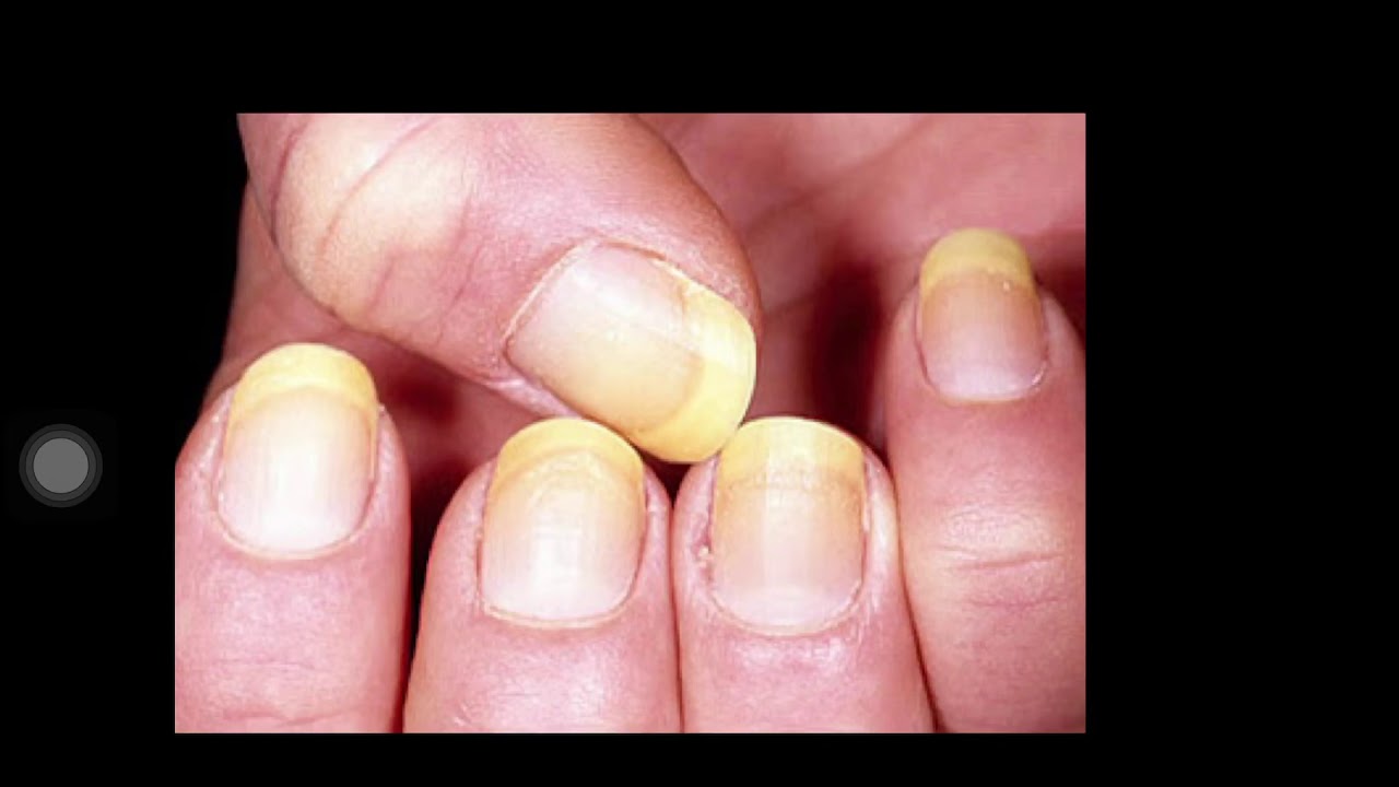 Yellow Nail syndrome OSCE medicine YouTube