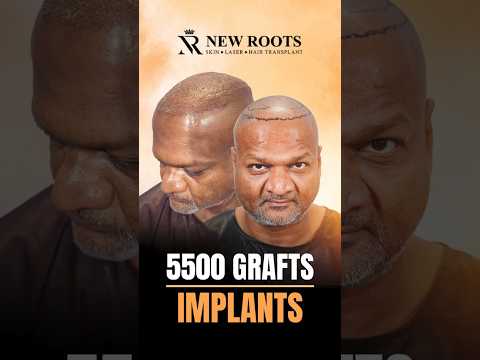 Hair Transplant in Pune - 5500 Grafts Implanted | Cost and Experience #hairtransplantcost #shorts