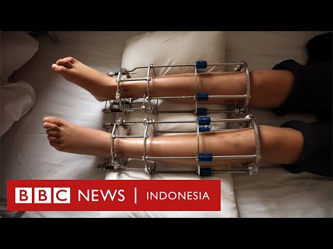 Video: Terapi Komplementer Untuk Crohn: Suplemen Dan Banyak Lagi