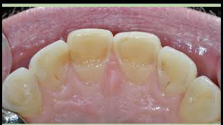 NECADE Session #34 - Dentin Bonding