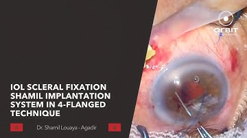 IOL Scleral fixation: Shamil Implantation System in 4-flanged Technique