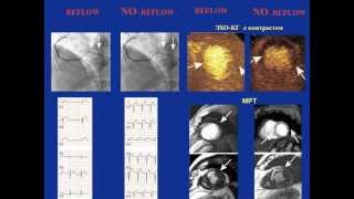 Лечение инфаркта миокарда часть 2   Кошкина Е.В