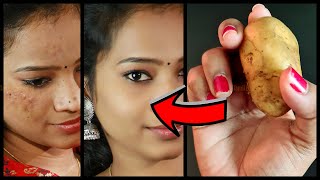 Face Pack for Oily Skin in Tamil | Pimple Acne Treatment