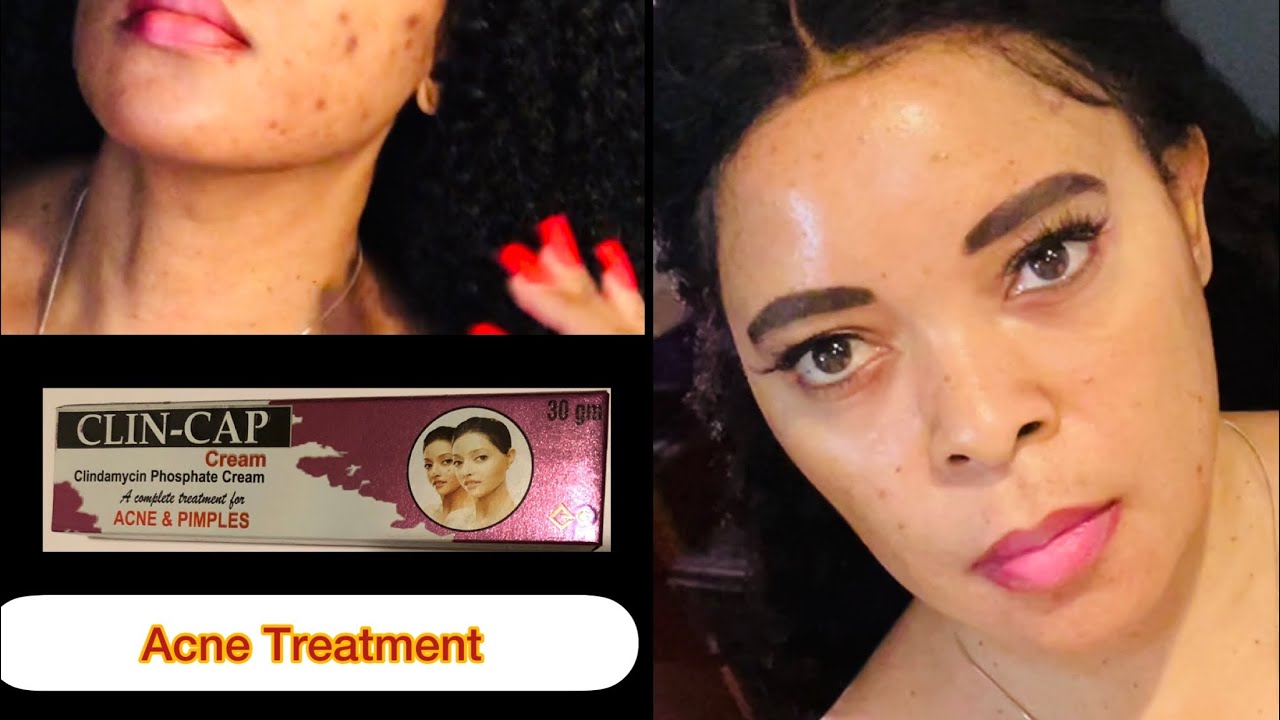 How to Clear Acne Pimples & Blemishes. ClinCap Cream Effective Treatment for Acne & Pimples