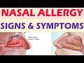 Nasal Allergy Symptoms | DR Anjaneyulu | Health And Beauty