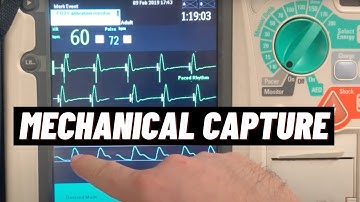 How to Confirm Mechanical Cardiac Capture for Transcutaneous Pacing TCP on Philips HeartStart MRx?
