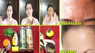 चेहरे के पीले दानें, पिम्पल घर बैठे हटाएँ | Remove Skin Bumps at Home