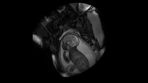 MRI scan at 30 weeks