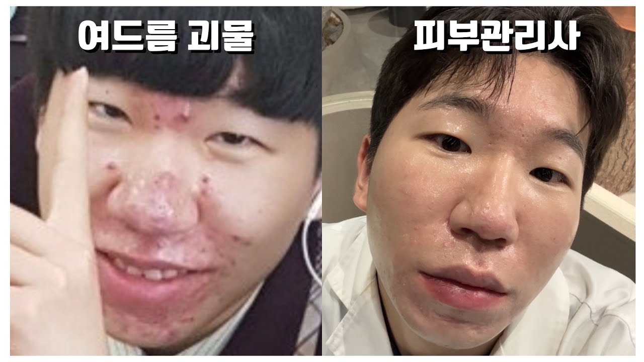 “야, 씻고 좀 다녀라” 8년 여드름 괴물 탈출, 가장 중요한 1가지