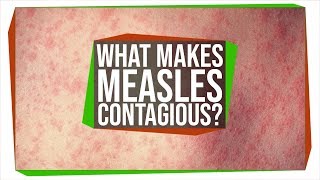 Why Is The Measles Virus So Contagious?