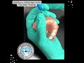 Dr. Walters will show you two effective methods for turning a palate expander