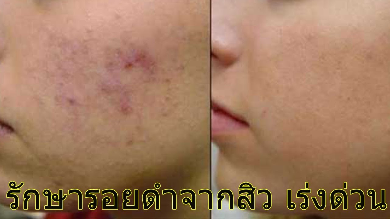 วิธีลดรอยสิว